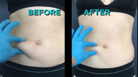 Tummy tuck melville ny  Our New York plastic and cosmetic surgeons have the answers to your questions about Mini Tummy Tuck such as recovery time, cost of surgery, and more